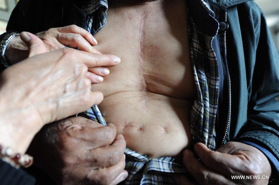 Li Chen, a Japanese abandoned chemical weapon victim, shows a surgery scar during a hearing event in Harbin, capital of northeast China's Heilongjiang Province, April 29, 2014. 